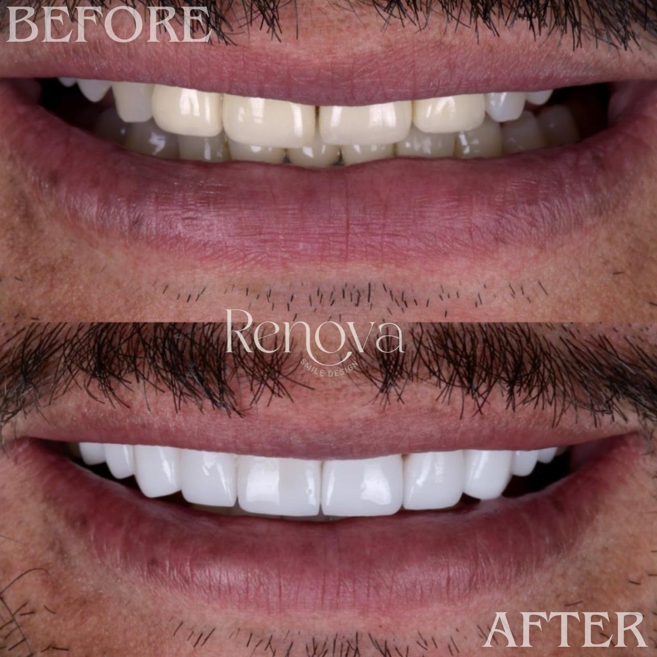 Before and after smile design - male patient
