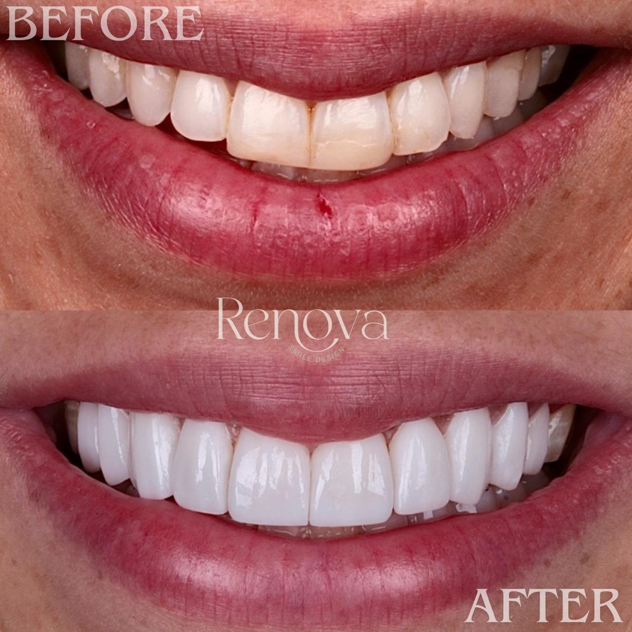 Before and after smile design - smile correction